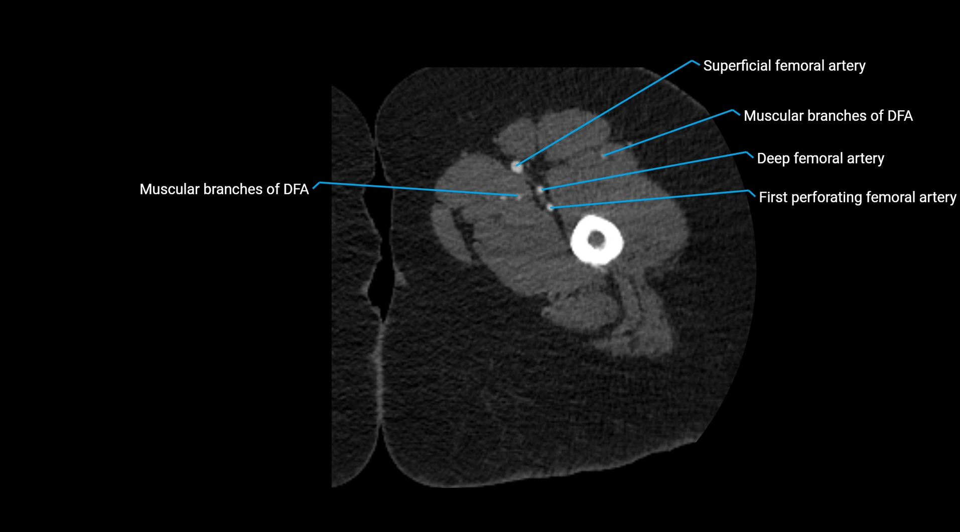 CTA lower limb cross sectional anatomy labelled image _94.webp